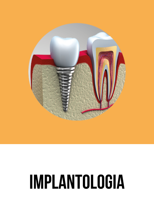 Implantologia